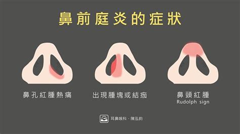 鼻孔裡面有一顆|鼻內「痘」腫痛？ 當心「鼻前庭炎」惡化